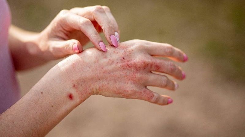 10 bệnh da liễu thường gặp và biện pháp phòng ngừa hiệu quả